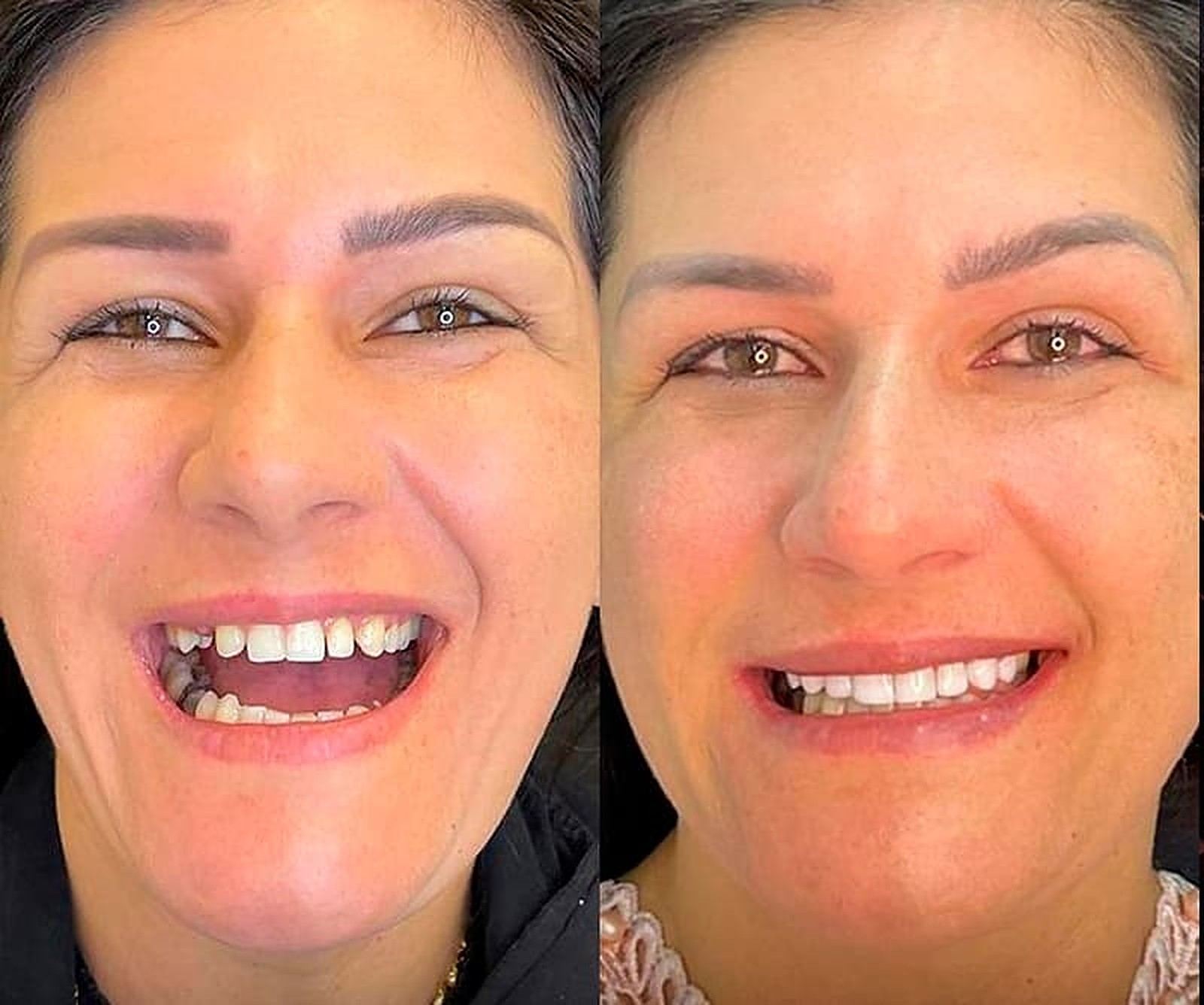 Implante dentário