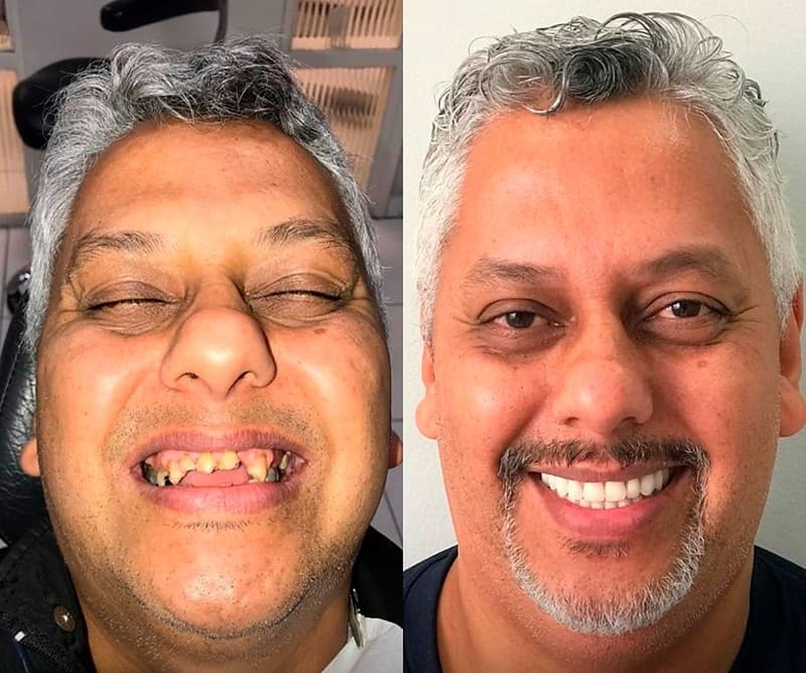 Implante dentário