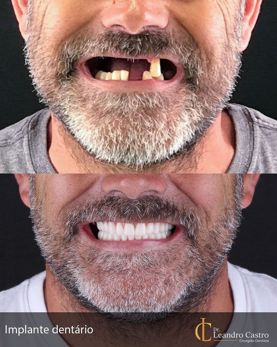 Implante dentário