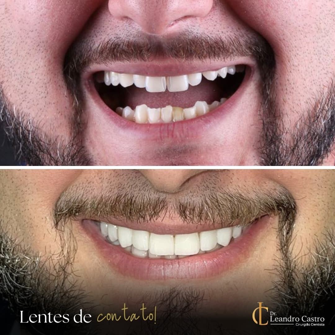 Lentes de contato